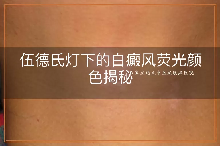 伍德氏灯下的白癜风荧光颜色揭秘