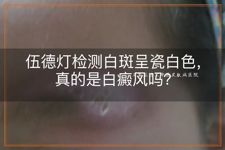 伍德灯检测白斑呈瓷白色，真的是白癜风吗？
