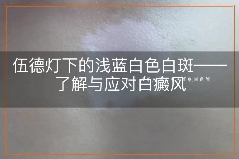 伍德灯下的浅蓝白色白斑——了解与应对白癜风