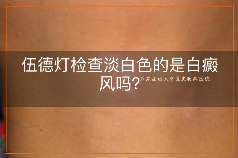 伍德灯检查淡白色的是白癜风吗？