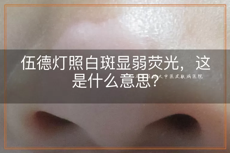 伍德灯照白斑显弱荧光，这是什么意思？