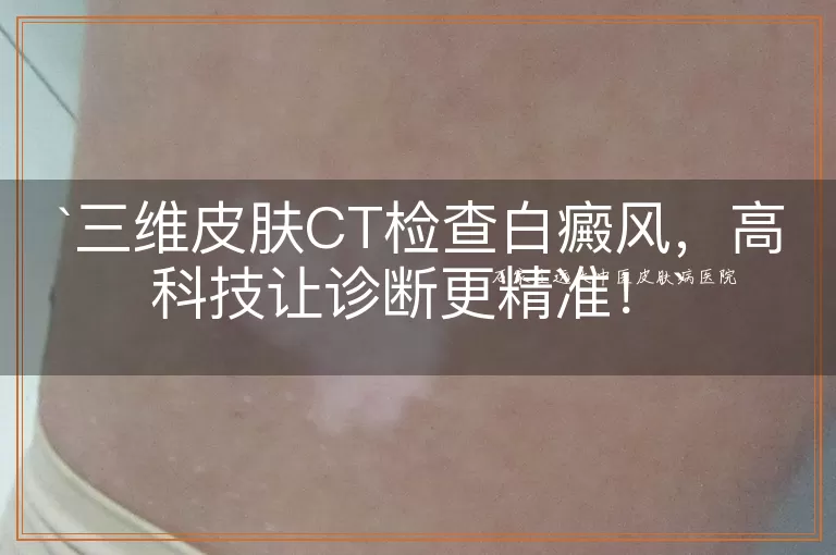 三维皮肤CT检查白癜风，高科技让诊断更精准！