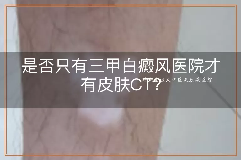 是否只有三甲白癜风医院才有皮肤CT？