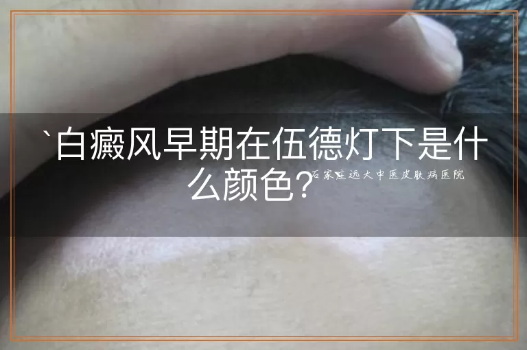 白癜风早期在伍德灯下是什么颜色？