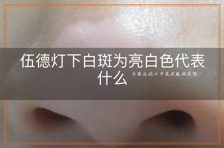 伍德灯下白斑为亮白色代表什么