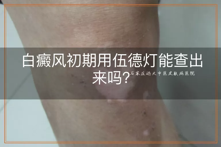 白癜风初期用伍德灯能查出来吗？