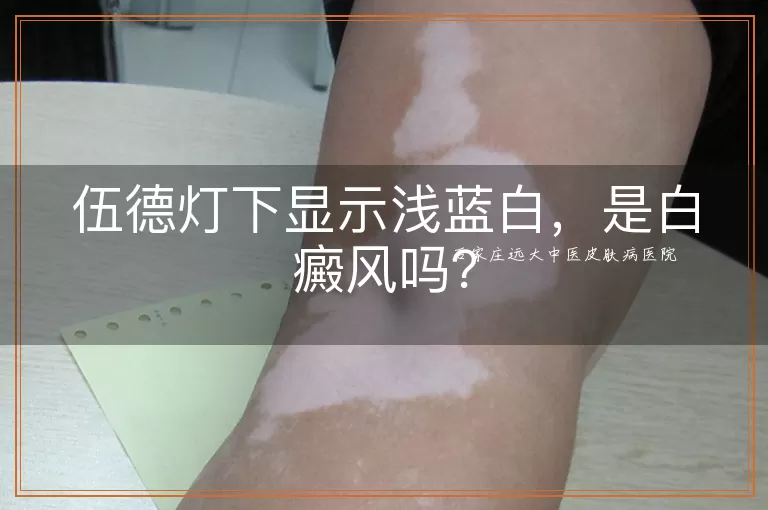 伍德灯下显示浅蓝白，是白癜风吗？