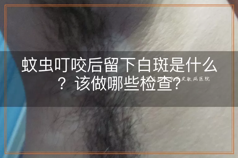 蚊虫叮咬后留下白斑是什么？该做哪些检查？