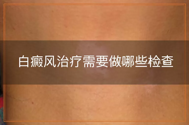 白癜风治疗需要做哪些检查