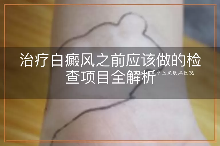 治疗白癜风之前应该做的检查项目全解析
