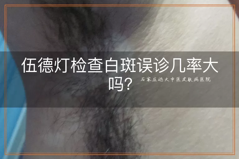 伍德灯检查白斑误诊几率大吗？