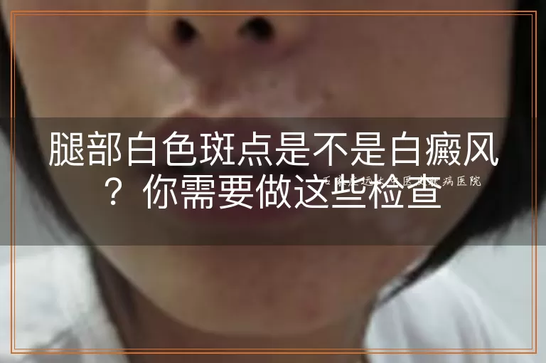 腿部白色斑点是不是白癜风？你需要做这些检查