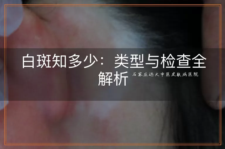 白斑知多少：类型与检查全解析