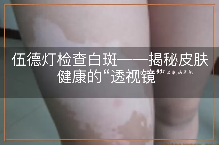 伍德灯检查白斑——揭秘皮肤健康的“透视镜”