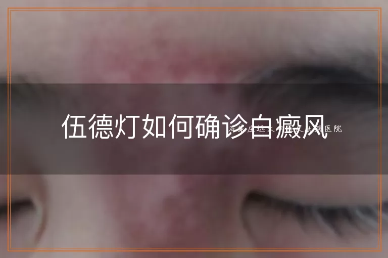 伍德灯如何确诊白癜风
