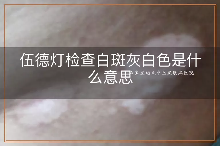 伍德灯检查白斑灰白色是什么意思