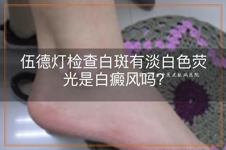 伍德灯检查白斑有淡白色荧光是白癜风吗？