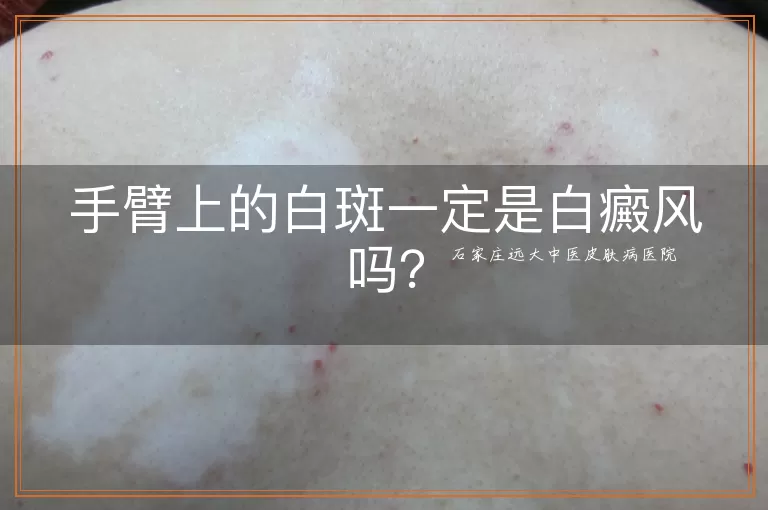 手臂上的白斑一定是白癜风吗？