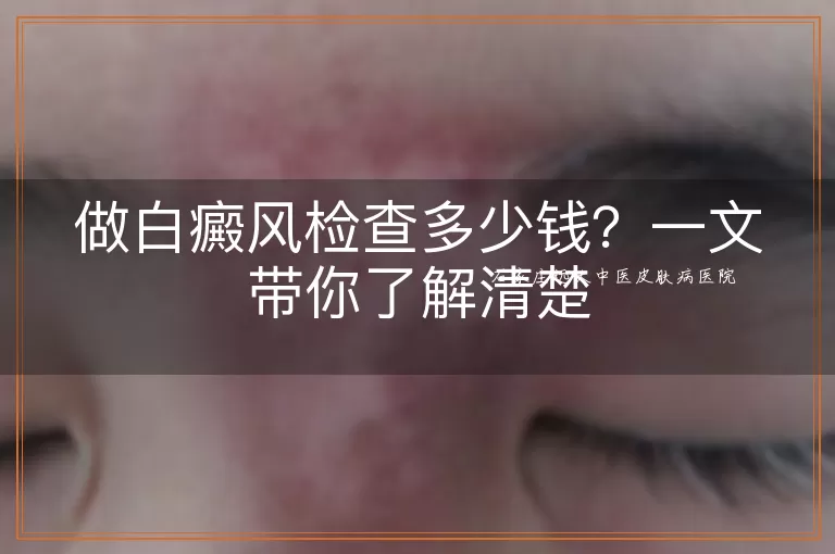 做白癜风检查多少钱？一文带你了解清楚