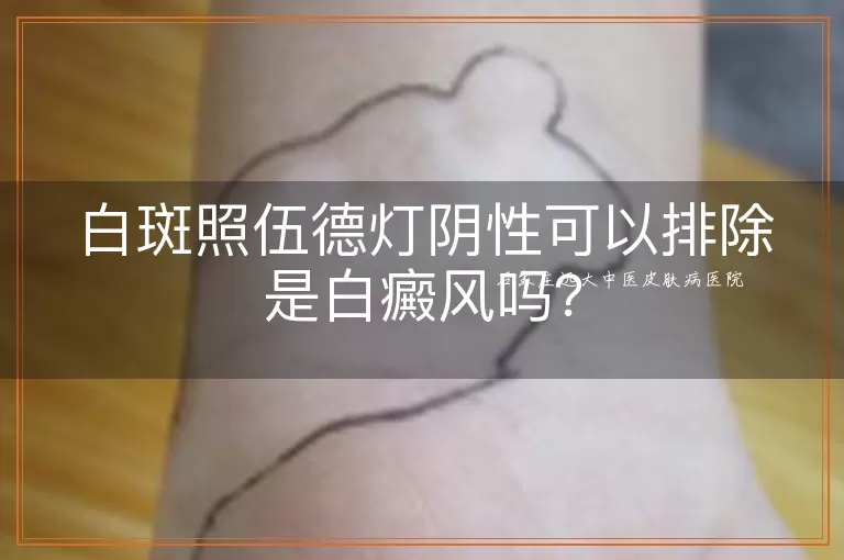 白斑照伍德灯阴性可以排除是白癜风吗？