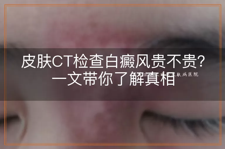 皮肤CT检查白癜风贵不贵？一文带你了解真相