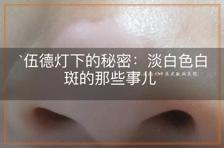 伍德灯下的秘密：淡白色白斑的那些事儿