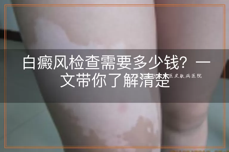 白癜风检查需要多少钱？一文带你了解清楚