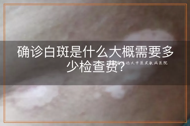确诊白斑是什么大概需要多少检查费？