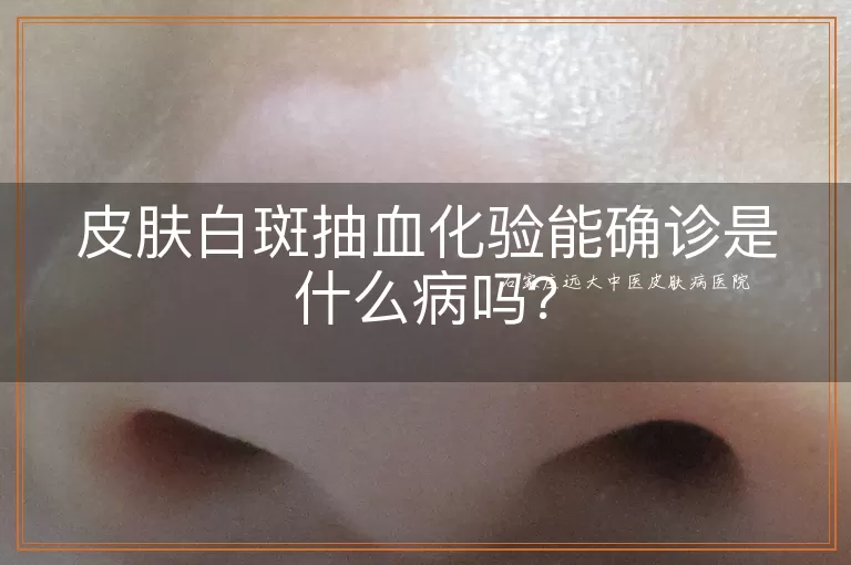 皮肤白斑抽血化验能确诊是什么病吗？
