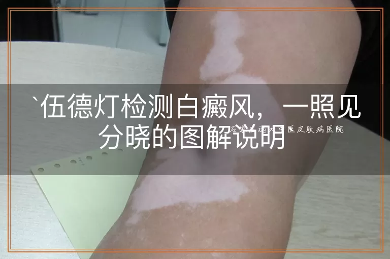 伍德灯检测白癜风，一照见分晓的图解说明