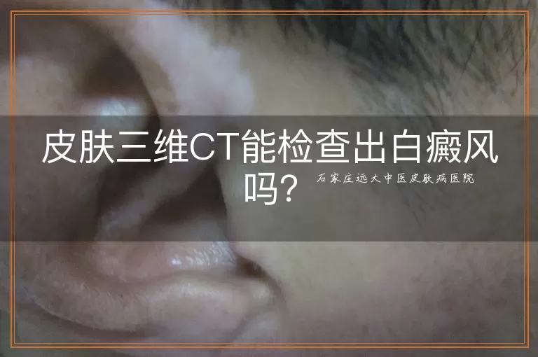皮肤三维CT能检查出白癜风吗？
