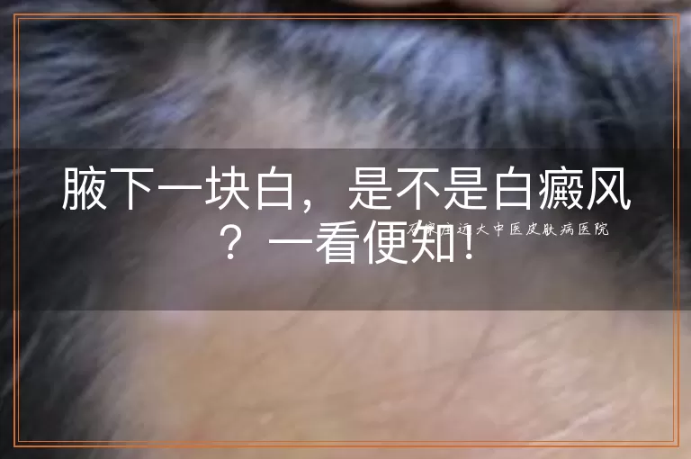 腋下一块白，是不是白癜风？一看便知！