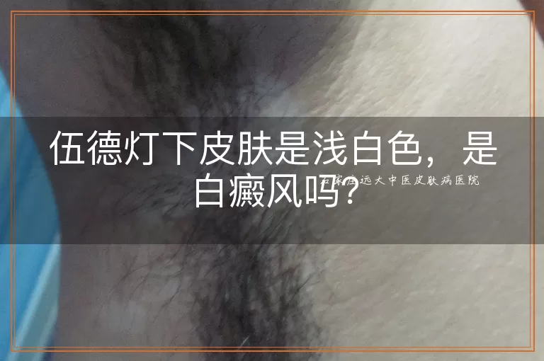 伍德灯下皮肤是浅白色，是白癜风吗？
