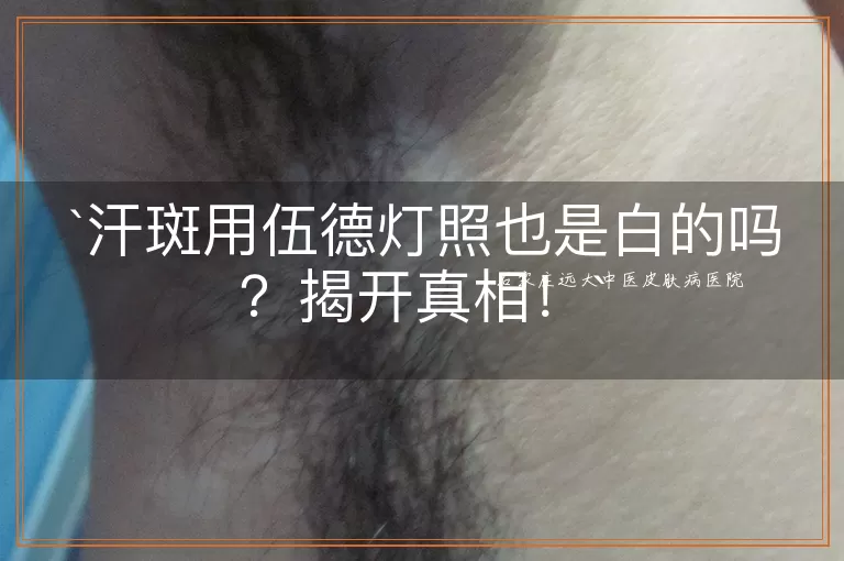 汗斑用伍德灯照也是白的吗？揭开真相！