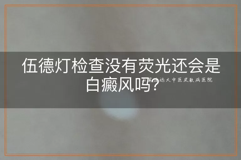 伍德灯检查没有荧光还会是白癜风吗?