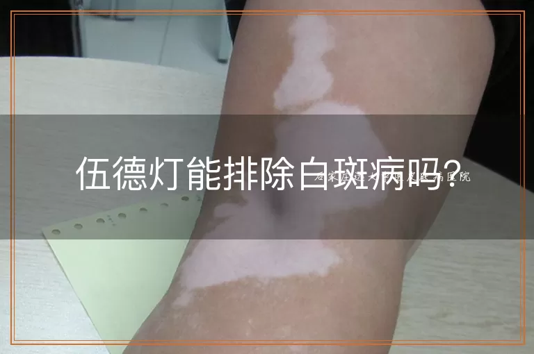 伍德灯能排除白斑病吗？
