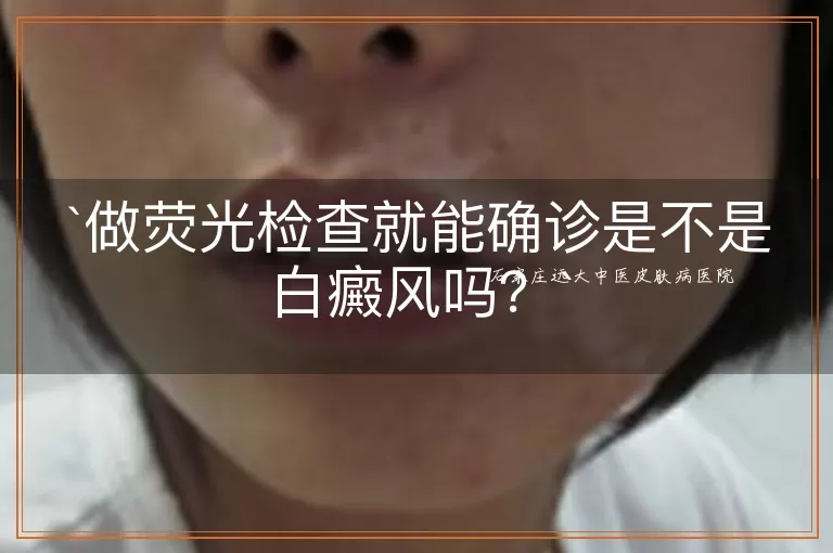 做荧光检查就能确诊是不是白癜风吗？