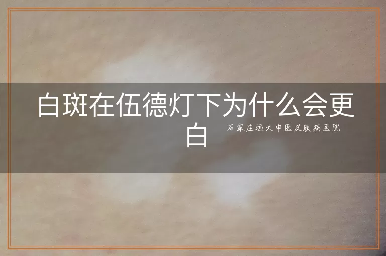 白斑在伍德灯下为什么会更白