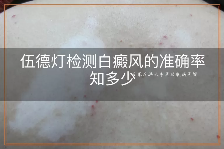 伍德灯检测白癜风的准确率知多少