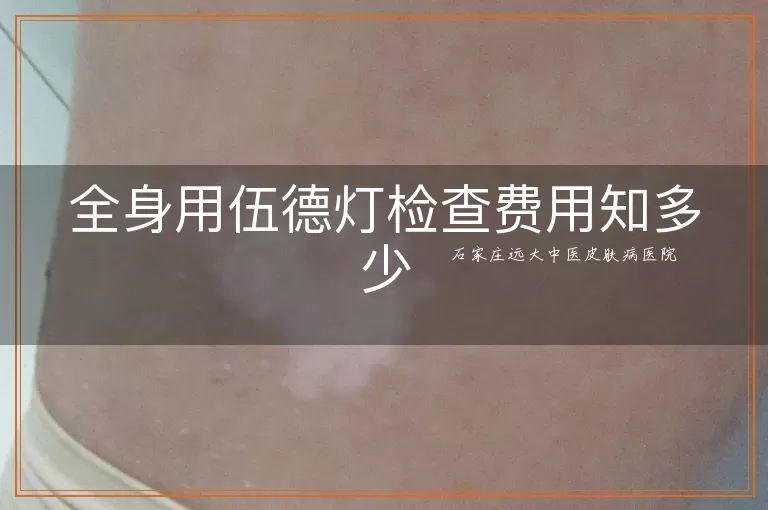 全身用伍德灯检查费用知多少