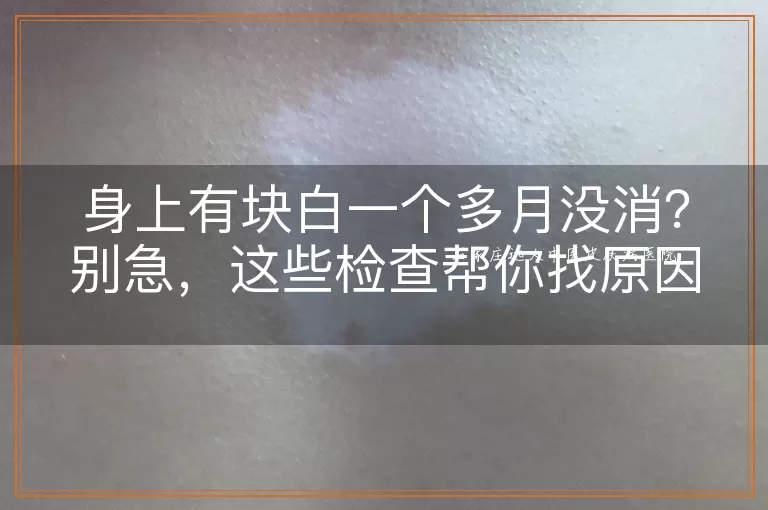 身上有块白一个多月没消？别急，这些检查帮你找原因！