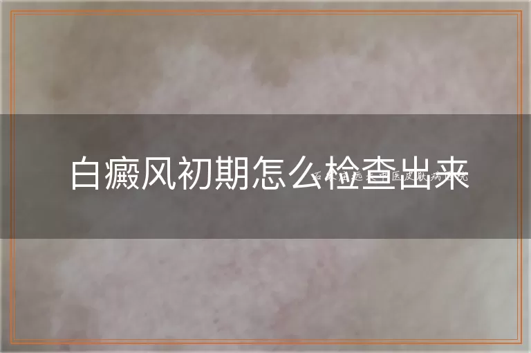 白癜风初期怎么检查出来