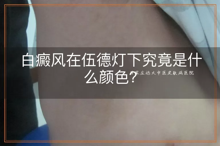 白癜风在伍德灯下究竟是什么颜色？