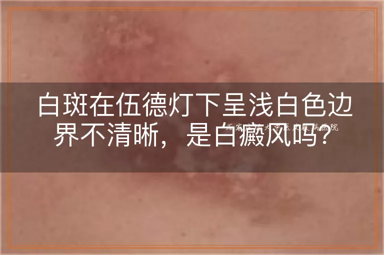 白斑在伍德灯下呈浅白色边界不清晰，是白癜风吗？