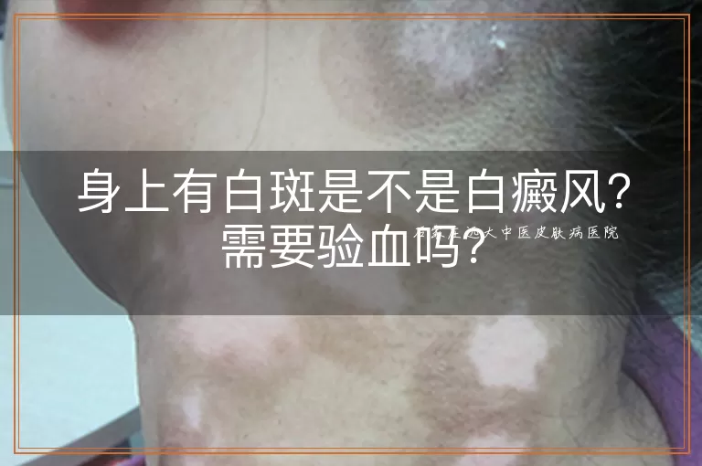 身上有白斑是不是白癜风？需要验血吗？