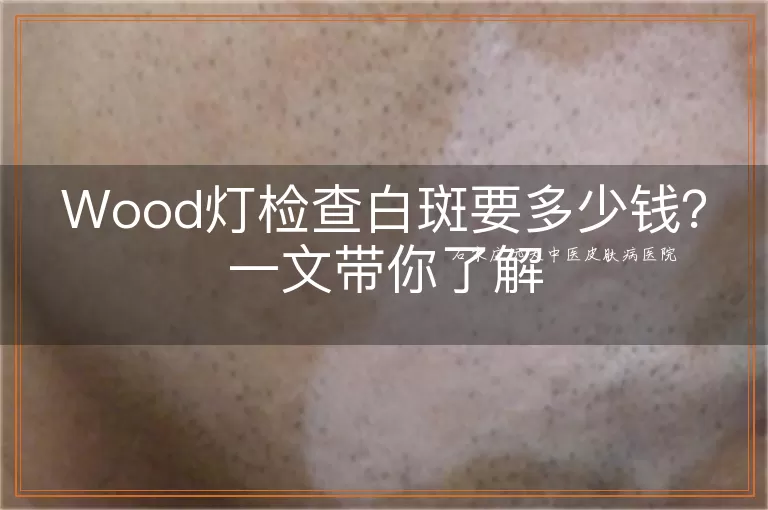 Wood灯检查白斑要多少钱？一文带你了解