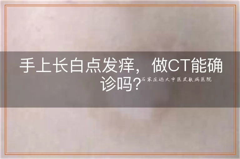 手上长白点发痒，做CT能确诊吗？