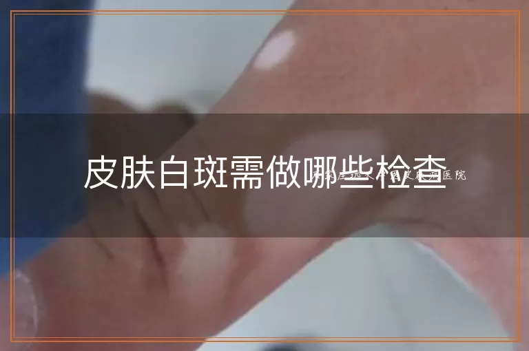 皮肤白斑需做哪些检查