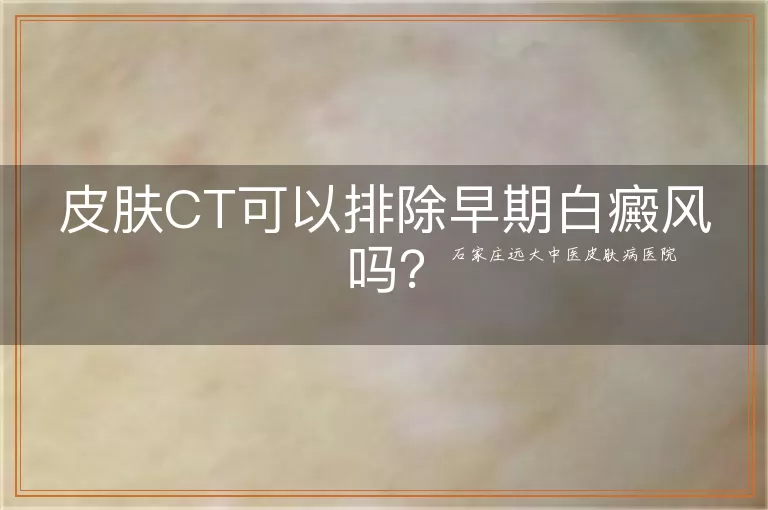 皮肤CT可以排除早期白癜风吗？