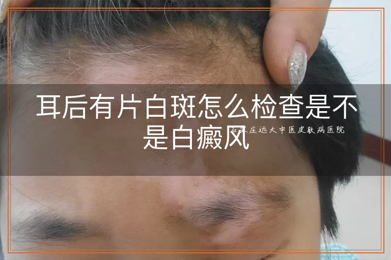 耳后有片白斑怎么检查是不是白癜风